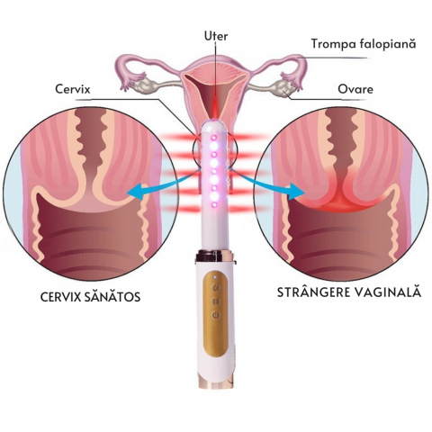 Bagheta Ginecologica cu Laser si Vibratii pentru Sanatatea Vaginala [22]