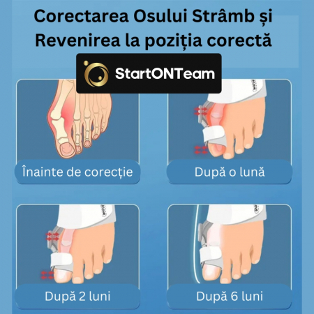 Corector Monturi Tech Love pentru Deget mare la Picioare Copii si Adulti [19]