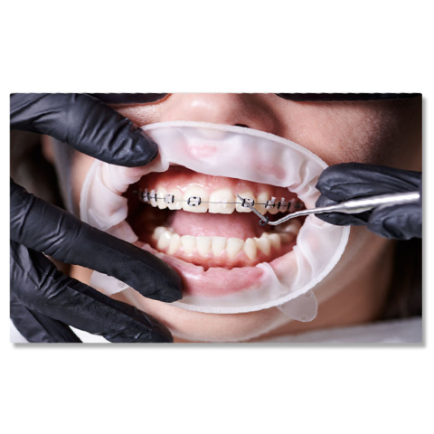 Meserii - Tablou Canvas: Zambet perfect - ortodontie, aparate dentare, femeie, clinica dentara 40x25CM