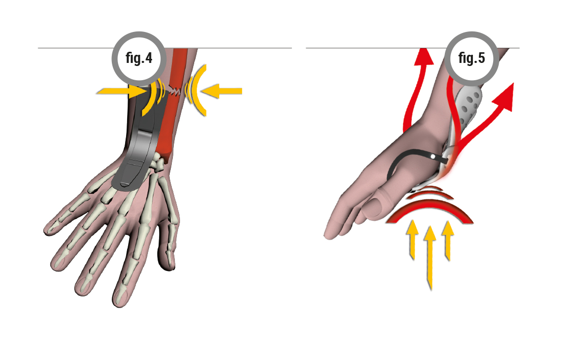 Fracture fig.1