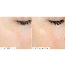 SkinBetter AlphaRet® Exfoliating Peel Pads [5]