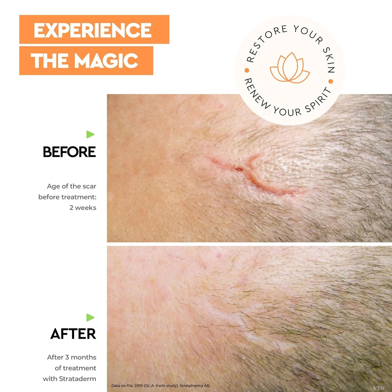 Strataderm Gel Siliconic pentru Terapia Profesională a Cicatricilor 50g [2]