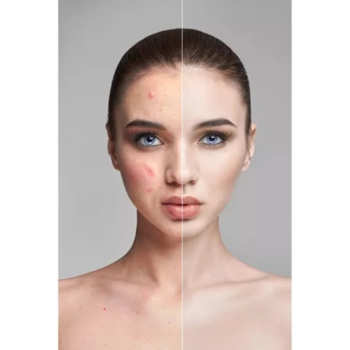 Rola dermatologica VarioShop®, pentru masaj facial, dermaroller 3 in 1, mezoterapie cu ace, pentru riduri, cicatrici, vergeturi, Auriu [2]