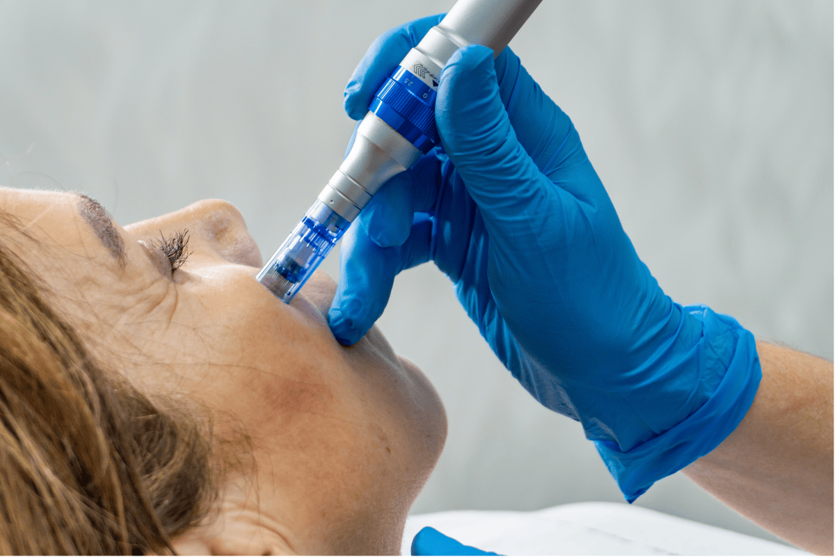 Tot ce trebuie să știi despre Dermapen