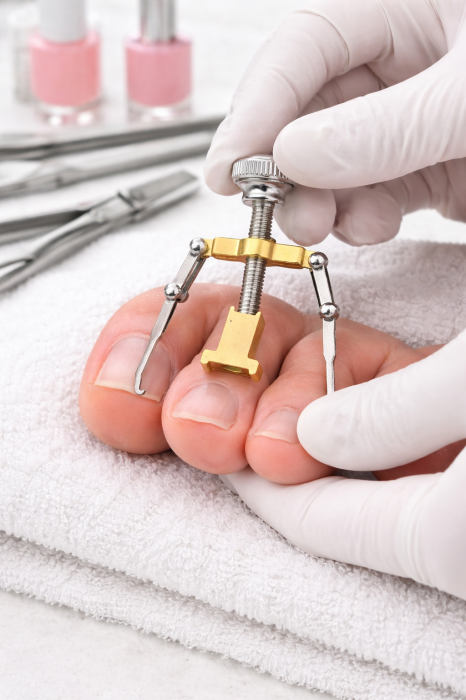 Corector Unghii Incarnate, Dispozitiv Reglabil cu 2 Brate, Instrument Pedichiura pentru Ridicare si Corectare Unghie [2]