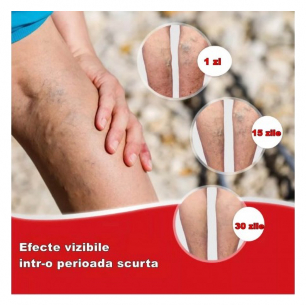 Set x 3 Pachete Plasturi Pentru Varice (vene varicoase), ALG™ , Senzatia de Picioare Grele si Obosite, din plante naturale,dimensiuni 7x10 cm, Pachet 12 Bucati [11]