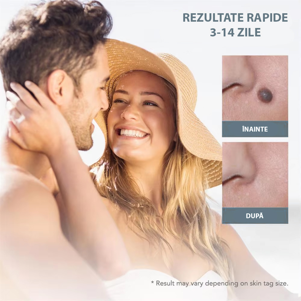 Dispositivo per Rimozione Papillomi ZAFIT®, Kit per Rimozione Skin Tag, per Viso, Collo, Corpo, Dimensioni 2-8 mm, 10 Salviette alcoliche, 40 Fasce elastiche, 2 Testine, Grigio [2]