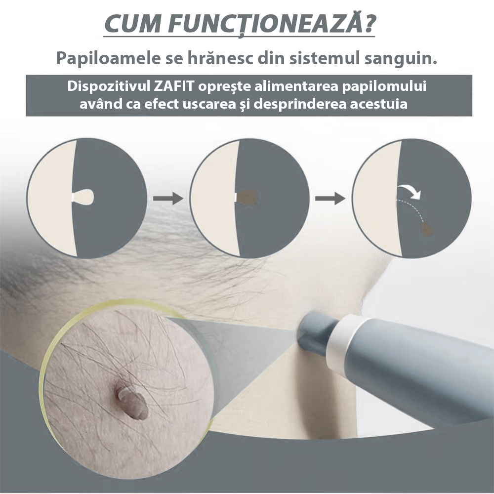 Dispositivo per Rimozione Papillomi ZAFIT®, Kit per Rimozione Skin Tag, per Viso, Collo, Corpo, Dimensioni 2-8 mm, 10 Salviette alcoliche, 40 Fasce elastiche, 2 Testine, Grigio [3]