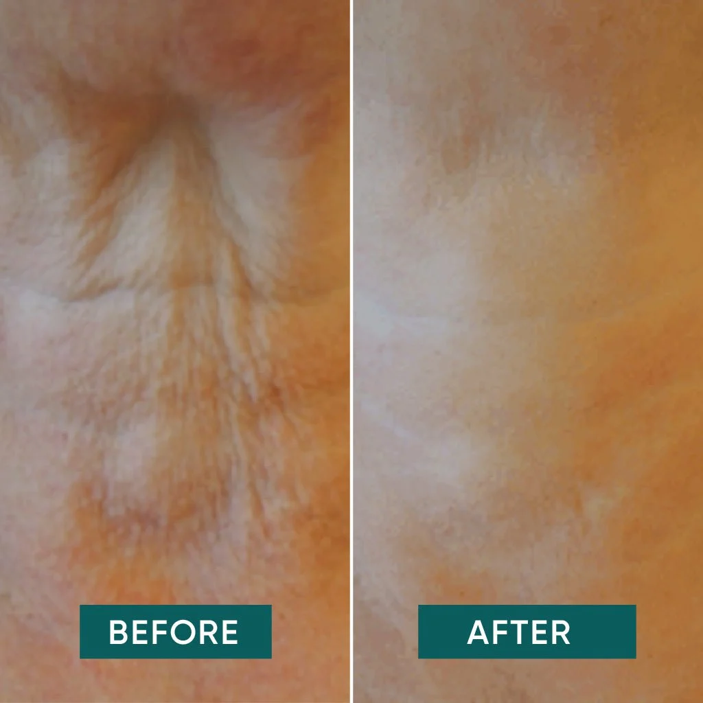 plasture-antirid-silicon-medical-apricot-gat-acid-hialuronic-reutilizabil [5]