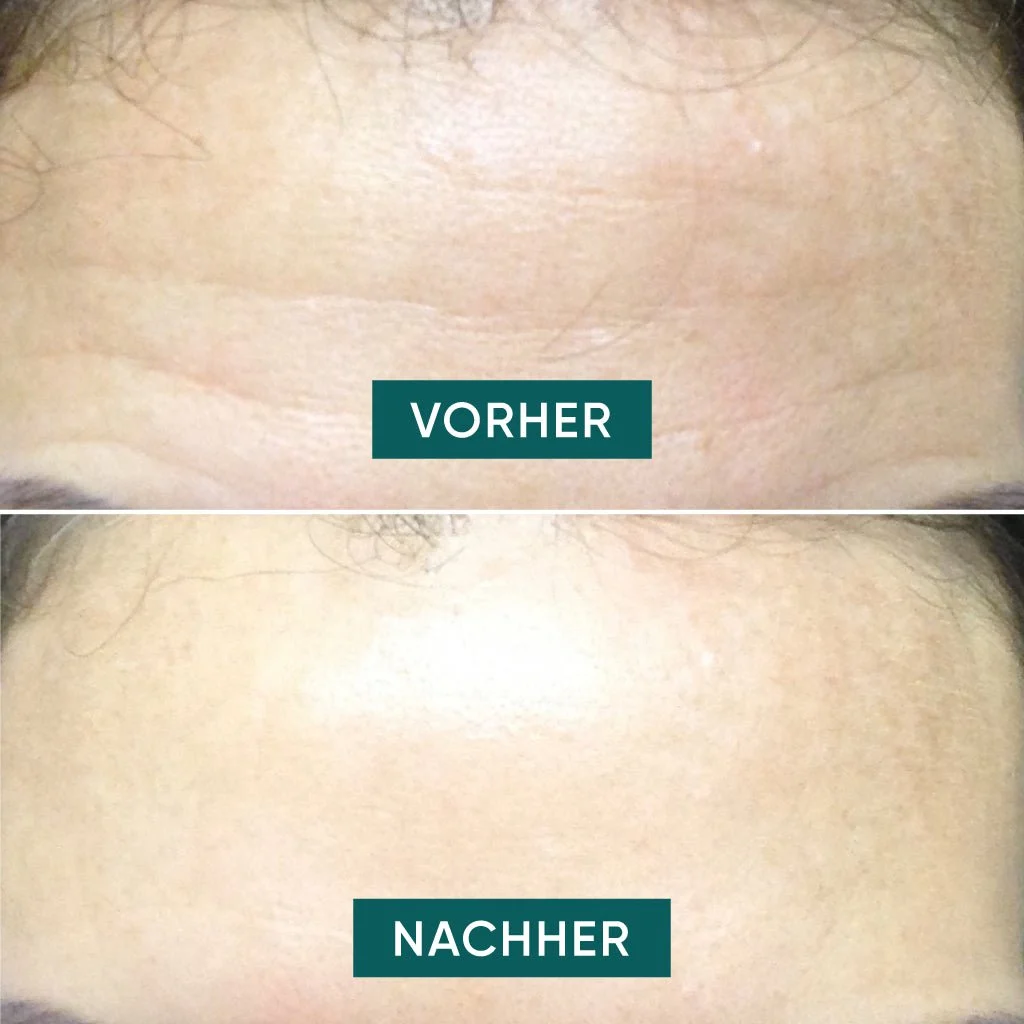 Plasture Reutilizabil Antirid Frunte Apricot - 30 Utilizări [3]