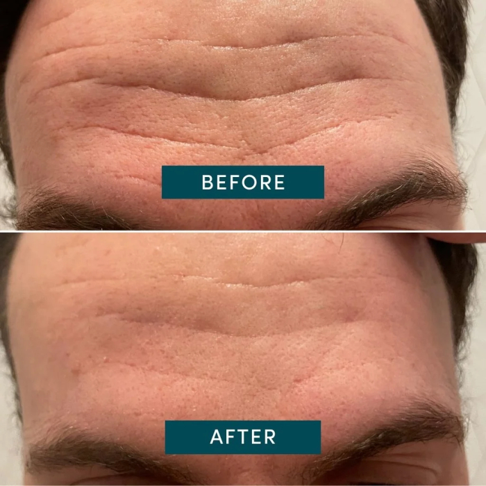 Plasturi Antirid Apricot cu Niacinamidă pentru Ridurile de Expresie, 100 bucăți [3]