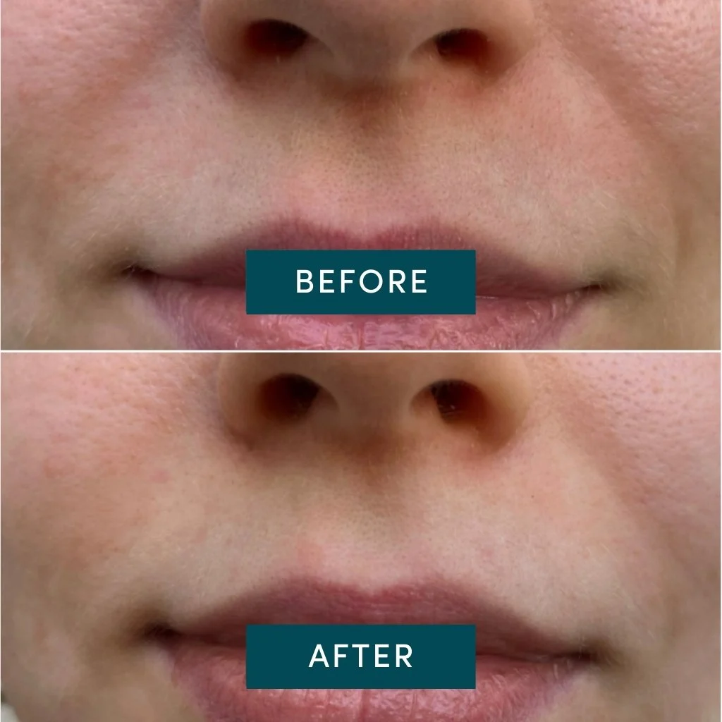 plasturi-antirid-bumbac-apricot-nazolabiala-niacinamida-24buc-ten-gras [4]