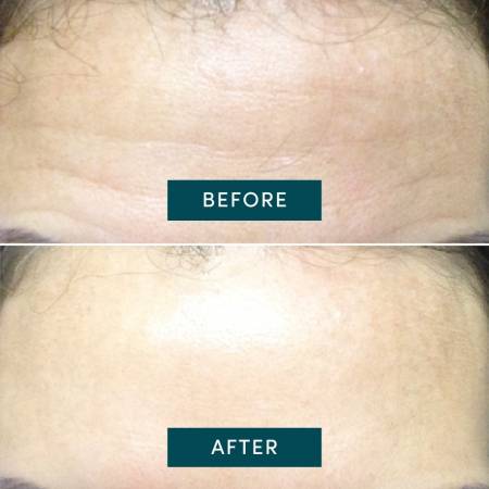 Plasture-Antirid-Frunte-Apricot-Hexapeptida-Reutilizabil [2]