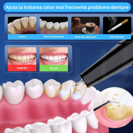 Aparat Ultrasonic pentru Detartraj Ultrasonic [1]