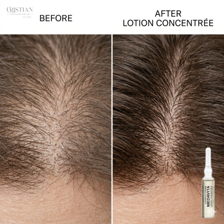 Set fiole Medavita Lotion Concentrée și cutie de prezentare – Ritual intensiv anticădere cu pH 3.5 [4]