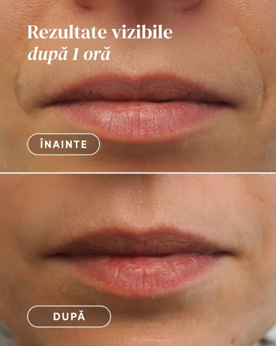 Plasturi APRICOT cu Acid Hialuronic pentru Zona Gurii și Nazolabială – 24 buc [4]