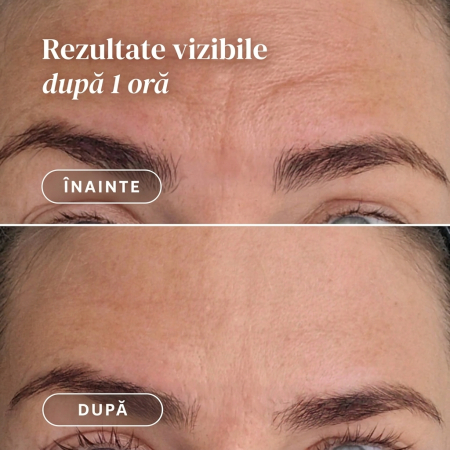 Plasture APRICOT pentru Frunte cu Acid Hialuronic pentru Hidratare și Riduri [4]