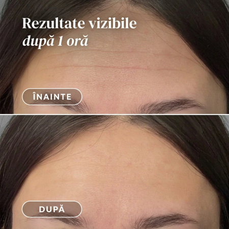Plasture APRICOT pentru Frunte cu Hexapeptidă pentru Linii de Expresie [4]