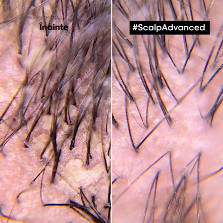 SE Scalp Advance Anti-Dandruff Shampoo 500 ml [4]