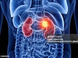 Rinichii și efortul fizic: cum ne protejăm filtrele vitale în sport și performanță