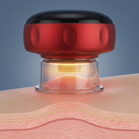 Smart Cupping Pro™ – Dispozitiv Inteligent de Masaj cu Ventuze, Încălzire și Vacuum Controlat pentru Relaxare Musculară și Recuperare [3]