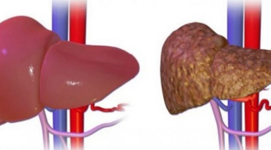 Bolile hepatice