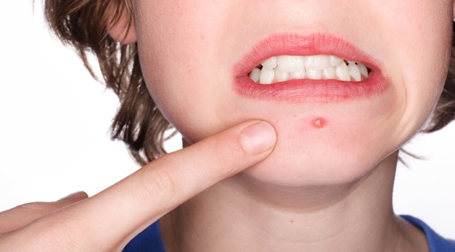 Insuportabila acne