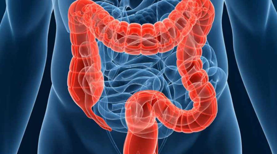 Semnele si factorii declansatori ai cancerului de colon