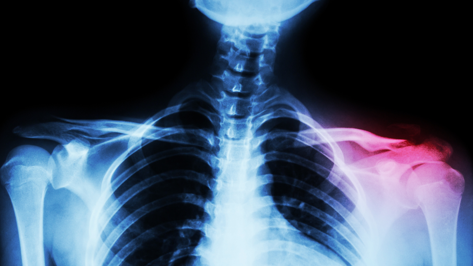 Fractura de Claviculă: Tot Ce Trebuie Să Știi