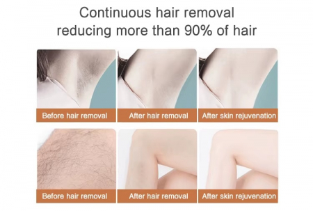 Epilator Premium IPL – Epilare Definitivă și Fără Durere Acasă [5]