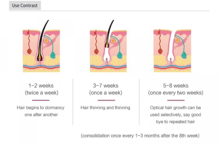 Epilator Premium IPL – Epilare Definitivă și Fără Durere Acasă [6]