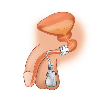 Artificial Urinary Sphincter ZSI 375 PF [2]