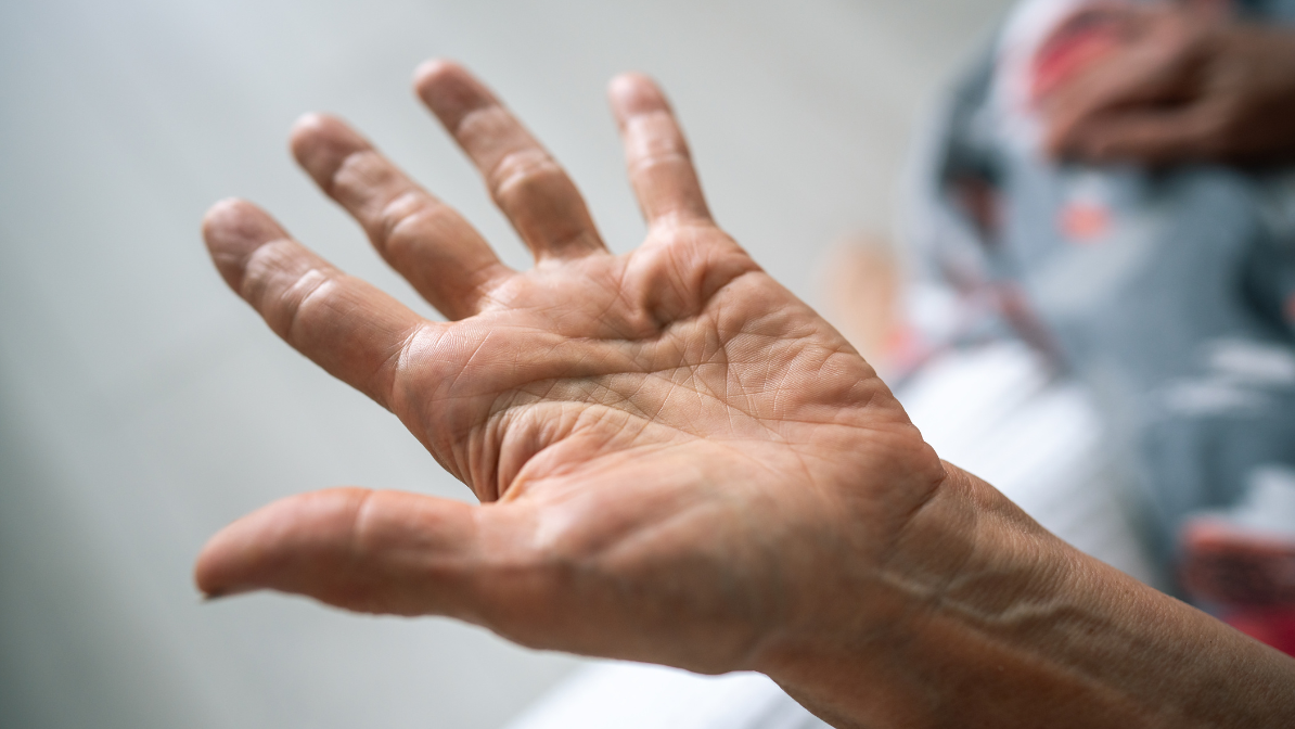 Boala Dupuytren: Cauze, Simptome, Tratament și Prevenție
