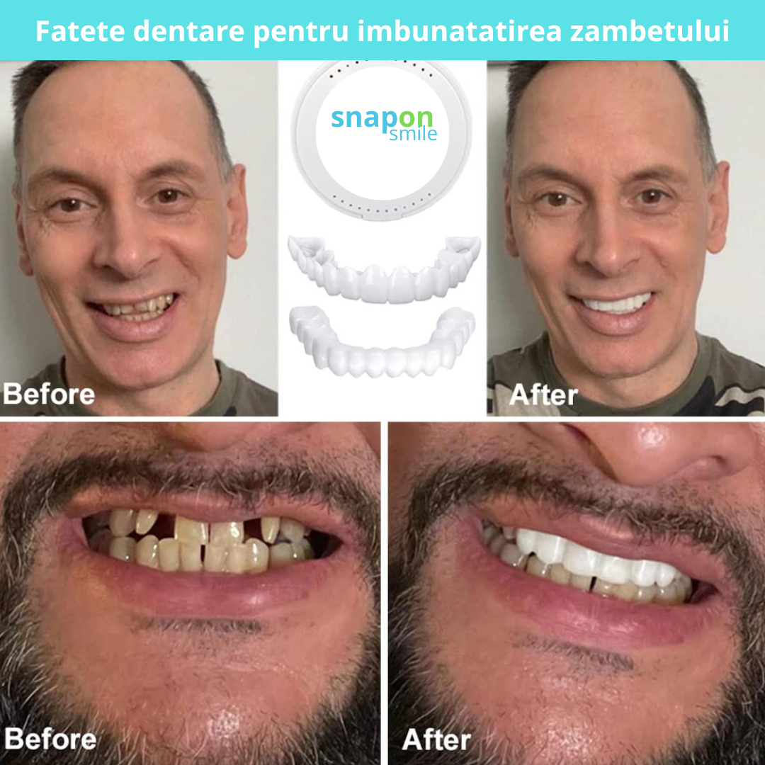 Kit SnapSmile – fațete dentare cosmetice