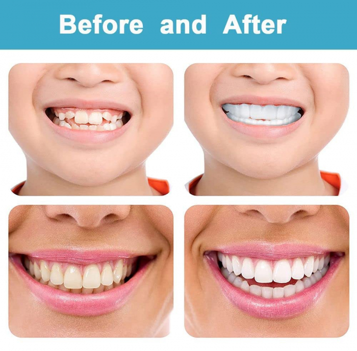 Fațete Dentare Cosmetice SnapSmile – Kit Complet pentru Zâmbet Alb Instant [6]