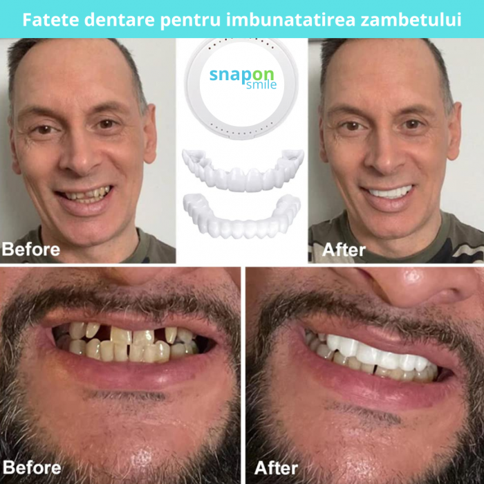 Fațete Dentare Cosmetice SnapSmile – Kit Complet pentru Zâmbet Alb Instant [4]
