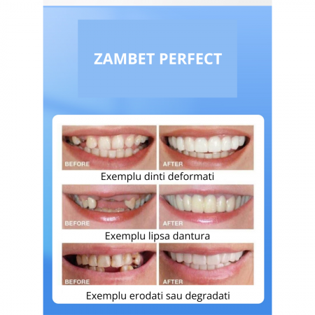 Fațete Dentare Cosmetice SnapSmile – Kit Complet pentru Zâmbet Alb Instant [4]