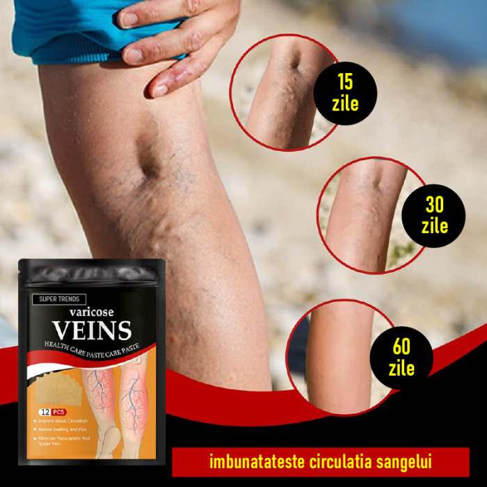 Plasturi Pentru Varice SUPER TRENDS®, Pentru Repararea Venelor Tip Panza de Paianjen, Indepartarea Varicelor, Set 12 buc [2]
