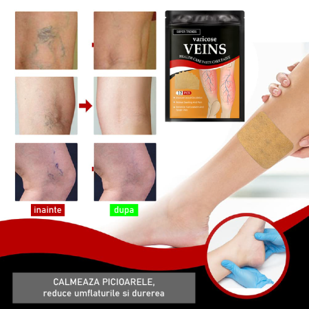 Plasturi Pentru Varice SUPER TRENDS®, Pentru Repararea Venelor Tip Panza de Paianjen, Indepartarea Varicelor, Set 12 buc [6]