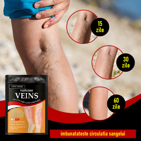 Plasturi Pentru Varice SUPER TRENDS®, Pentru Repararea Venelor Tip Panza de Paianjen, Indepartarea Varicelor, Set 12 buc [1]