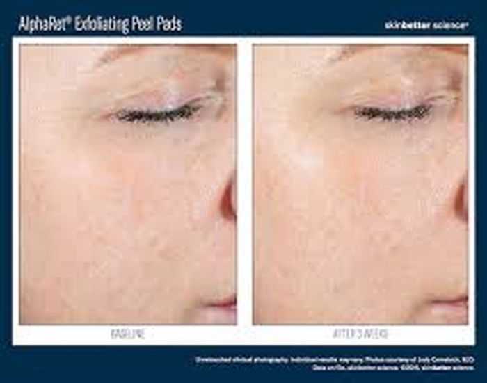 SkinBetter AlphaRet Exfoliating Peel Pads 30 buc. [6]