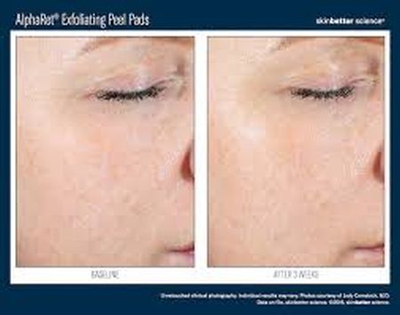 SkinBetter AlphaRet Exfoliating Peel Pads 30 buc. [5]