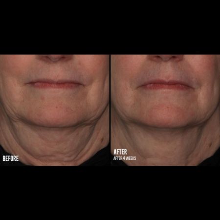 SkinBetter InterFuse Treatment Cream Face and Neck 30ml [1]