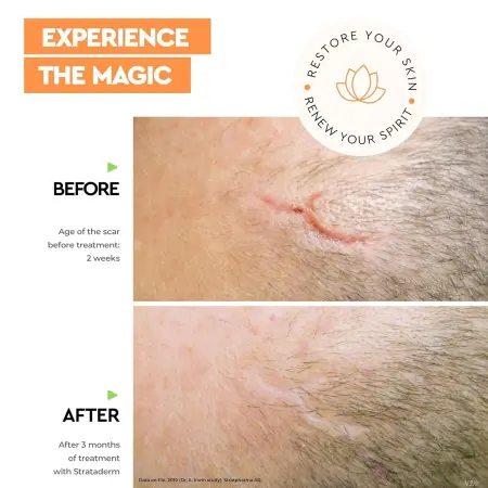 Strataderm, 50 g Gel Siliconic pentru Terapia Profesională a Cicatricilor [1]