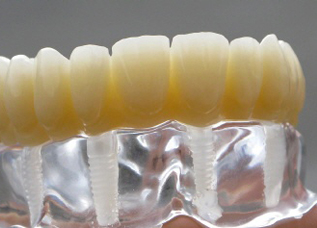 Dentalos Plus® (High-performance PMMA) [3]