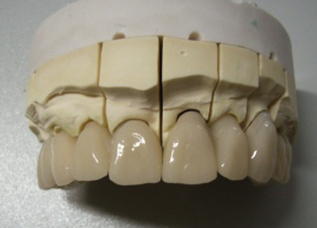 Dentalos Plus® (High-performance PMMA) [4]