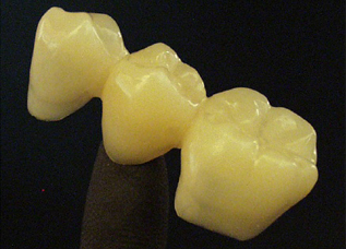 Dentalos Plus® (High-performance PMMA) [6]