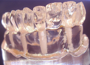 Shop - Dentalos Plus® (High-performance PMMA)