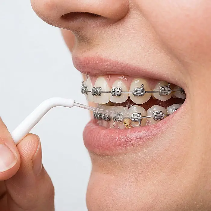 Irigator Bucal Manual pentru Igienă Orală – 40 ml, Jet de Apă Puternic, Curățare Interdentară, Alb, Fără Baterii sau Încărcare, Ideal pentru Aparat Dentar, Coroane și Punți [2]