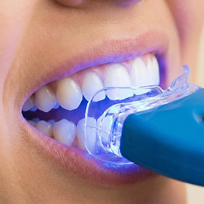 Dispozitiv pentru Albirea Dinților – Tratament Profesional Acasă, Tehnologie cu Lumină LED, Gel Inclus, Rezultate Vizibile în 20 de Minute, Pachet Complet cu Accesorii, Alb [3]